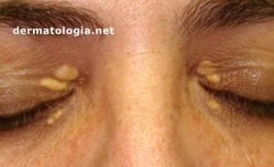 Xantelasma
