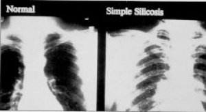 Silicose