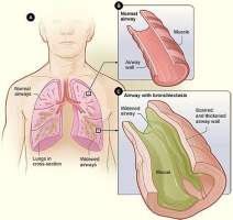Bronquiectasia