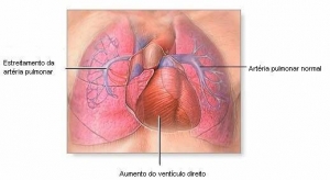 Hipertensão Pulmonar